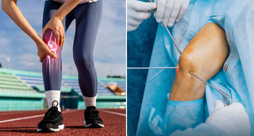 Arthroscopic Surgery