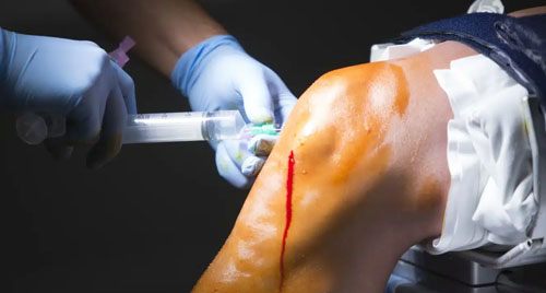 Joint Preservation Surgery