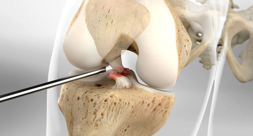 Ligament Reconstruction